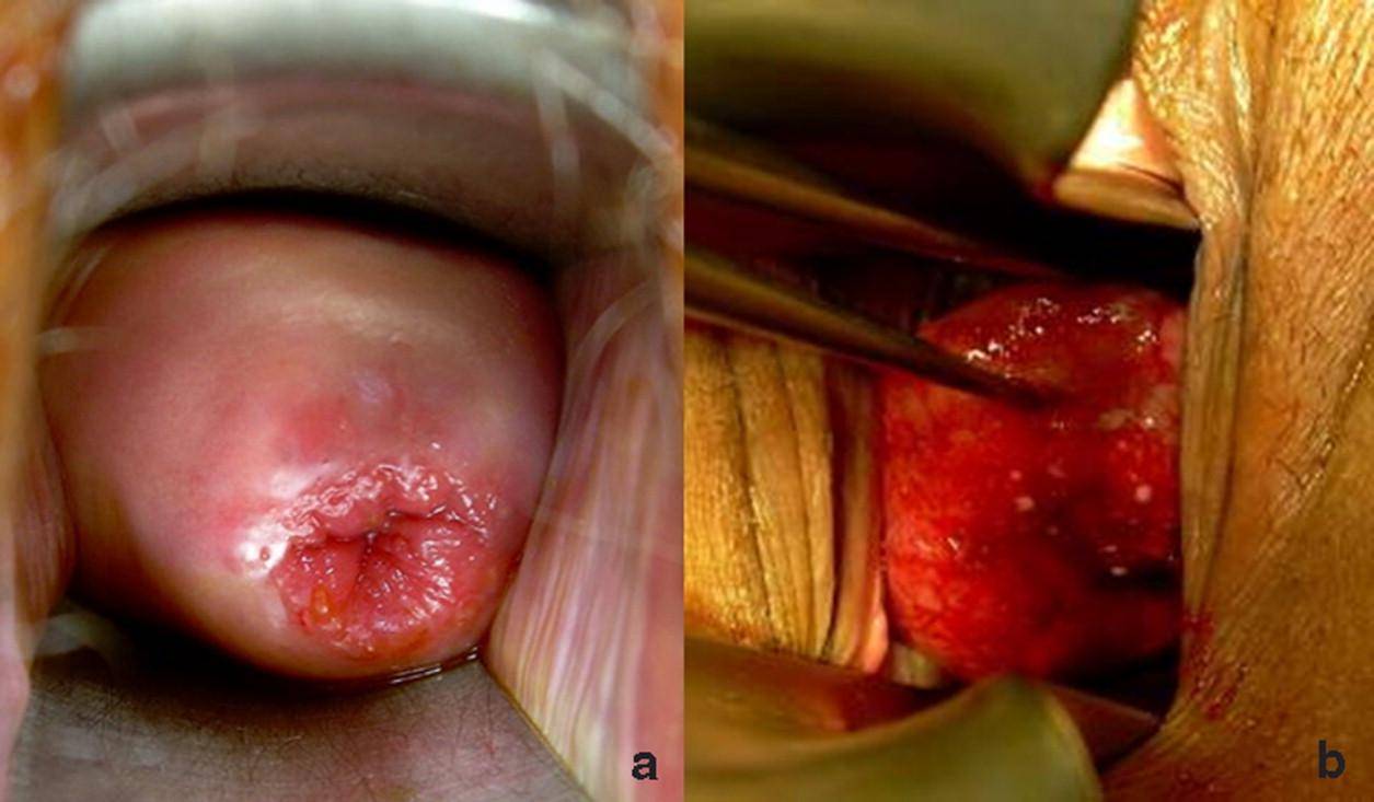 Rahim Ağzı Kanseri ve HPV: İspanya'nın Yok Olma Hedefi